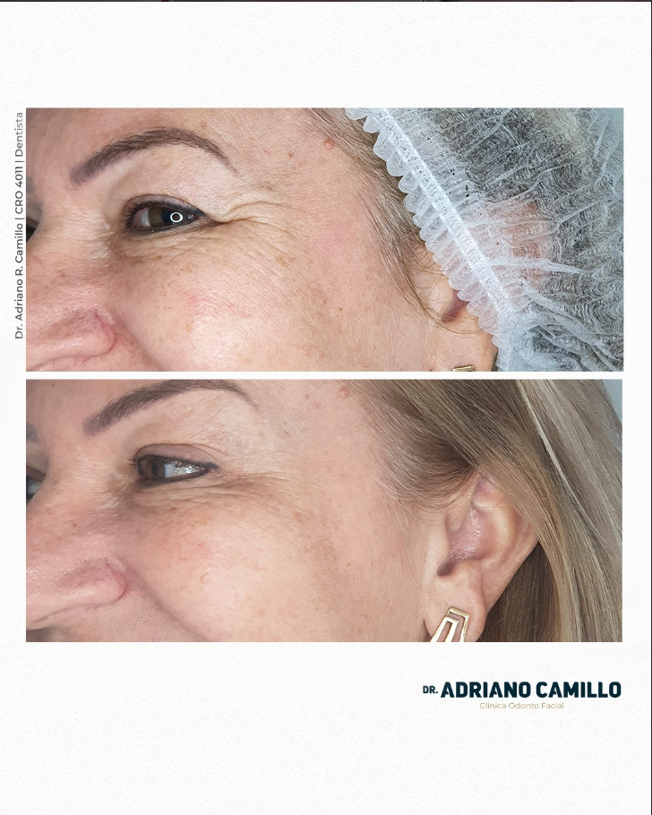 Harmonização Orofacial - Galeria 10