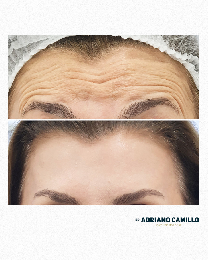 Harmonização Orofacial - Galeria 11
