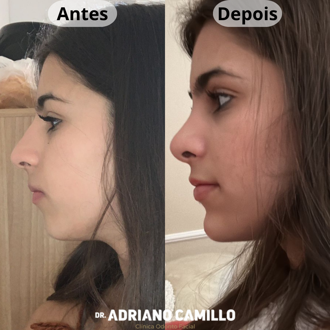 Harmonização Orofacial - Galeria 1