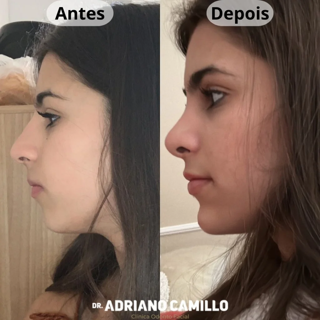 Alinhamento de Perfil Facial e Mento