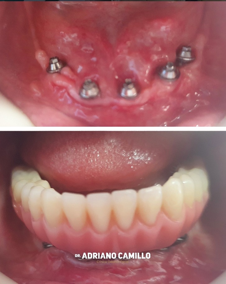 Implantes Dentários - Galeria 1
