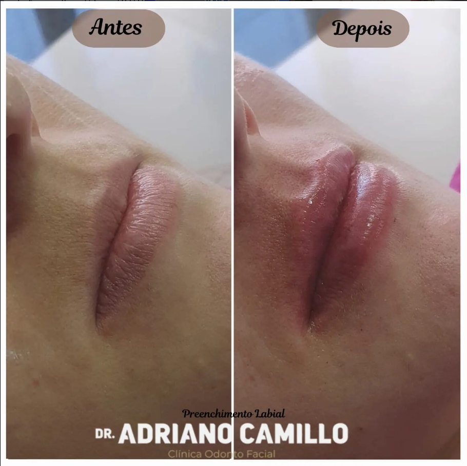 Harmonização Orofacial - Galeria 3
