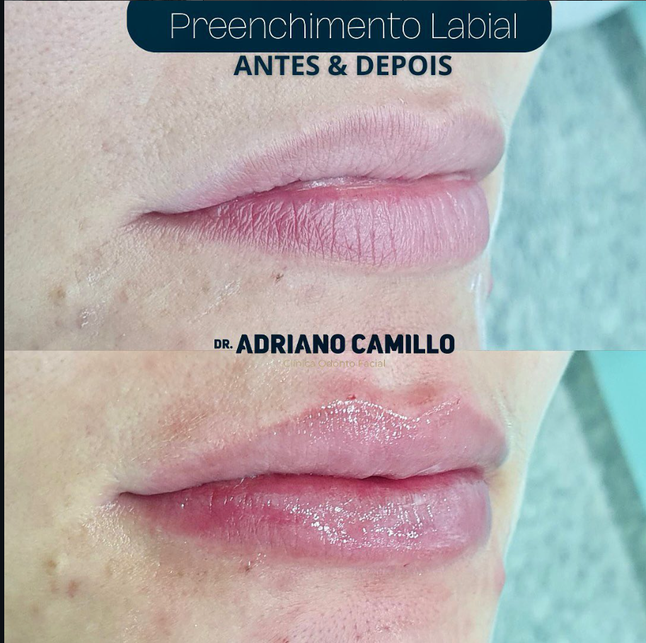 Harmonização Orofacial - Galeria 4