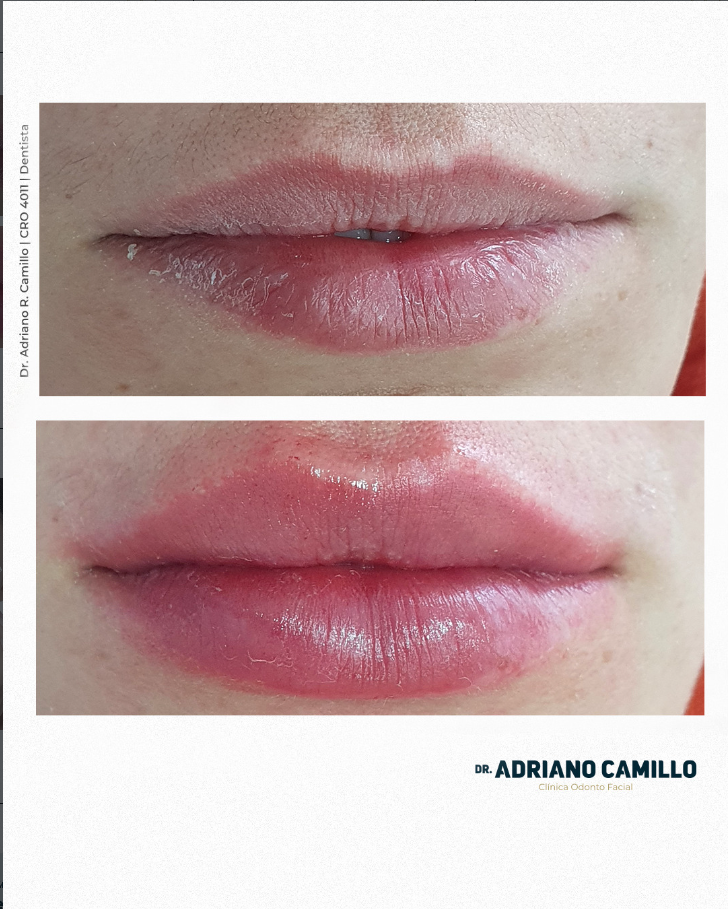 Harmonização Orofacial - Galeria 5
