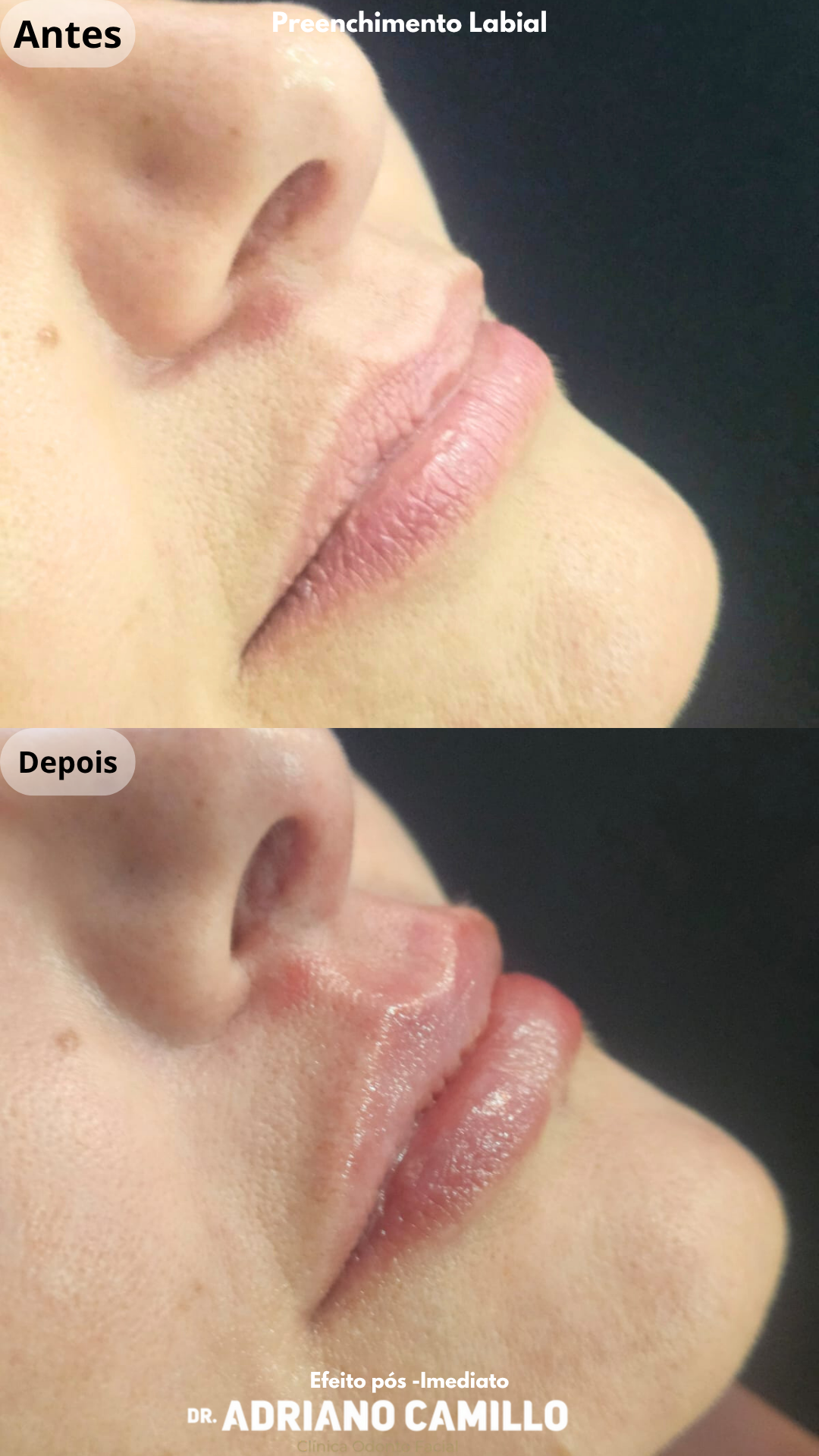 Harmonização Orofacial - Galeria 6