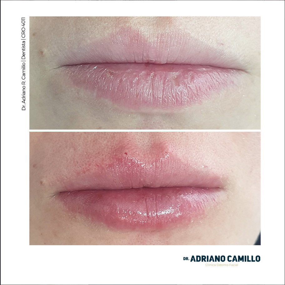 Harmonização Orofacial - Galeria 7