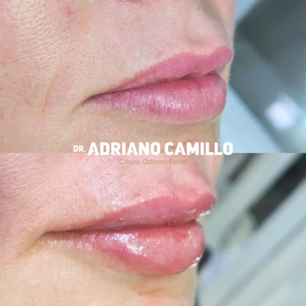 Restauração de Volume e Contorno Labial