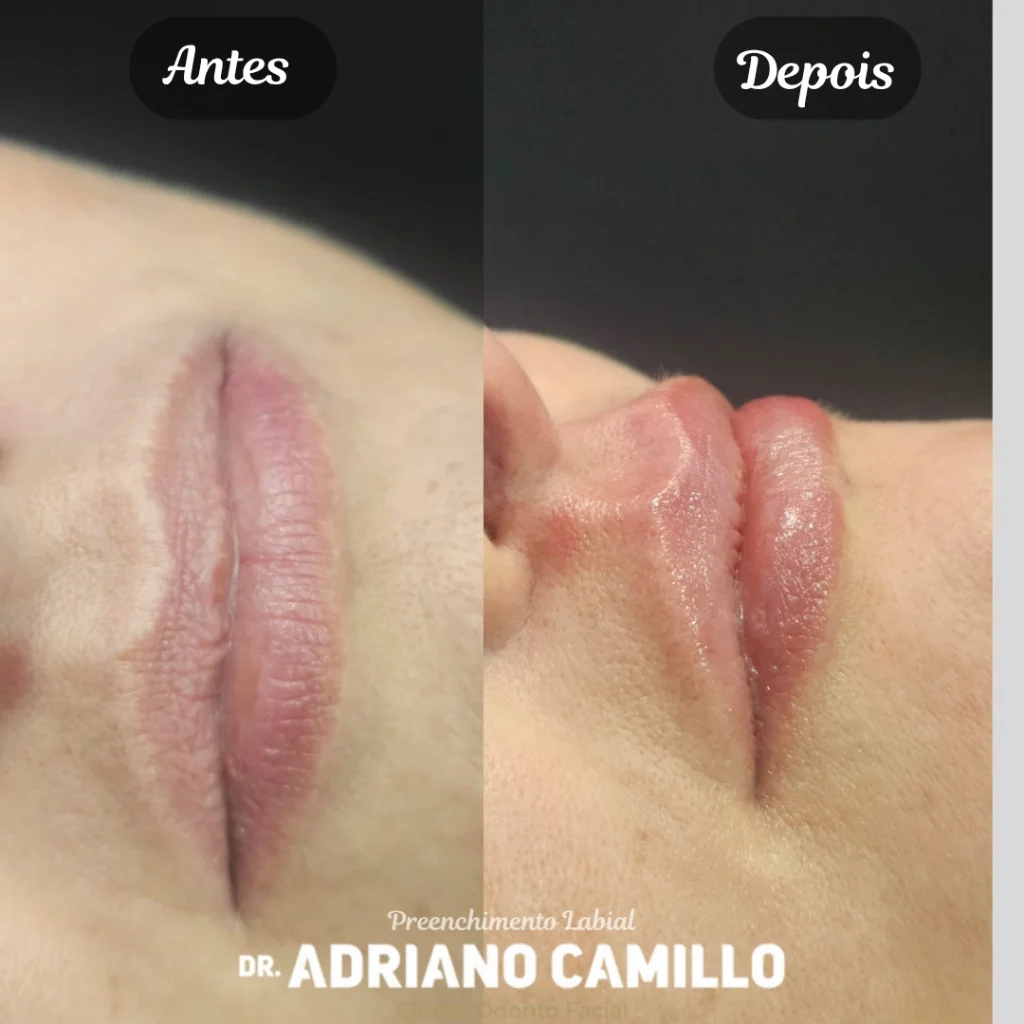 Harmonização Labial em Perfil