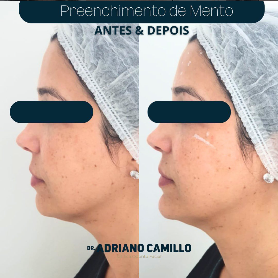 Harmonização Orofacial - Galeria 8