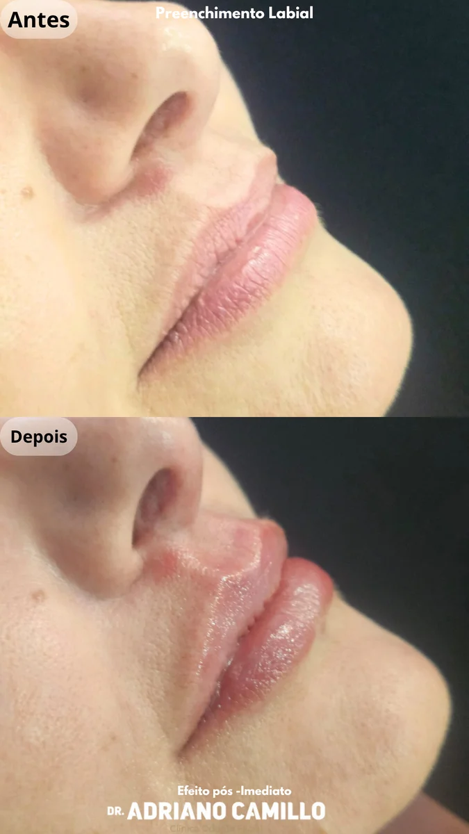 Refinamento do Contorno Mandibular